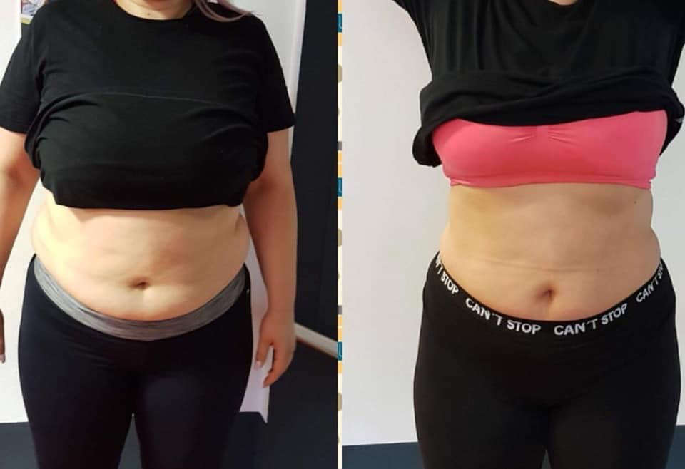 Kryolipolyse Ergebnis